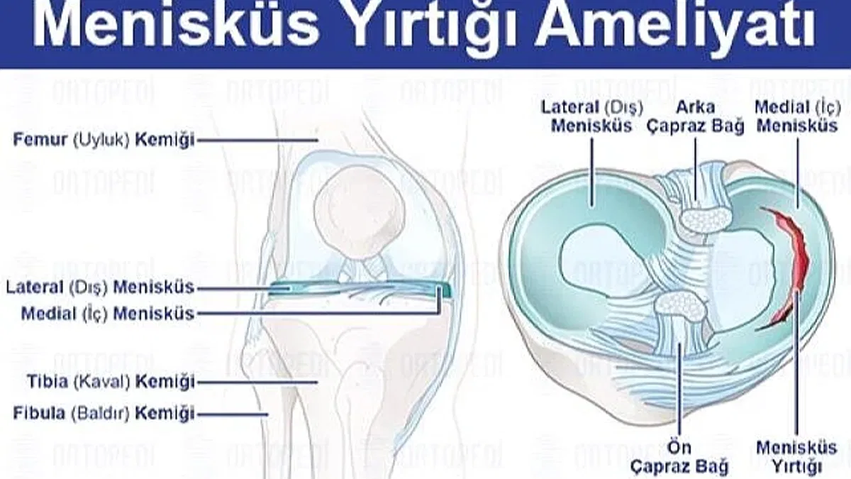 Menisküs Yırtığı: Belirtileri, Tedavi Yöntemleri ve Ameliyat Süreci