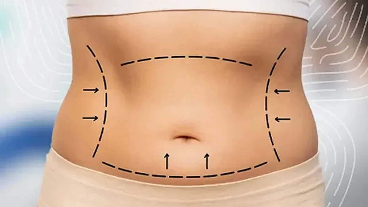 Liposuction ile Vücut Şekillendirmede Gerçekçi Beklentiler
