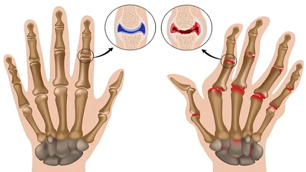Romatoid artriti kireçlenme ile karıştırmayın uyarısı