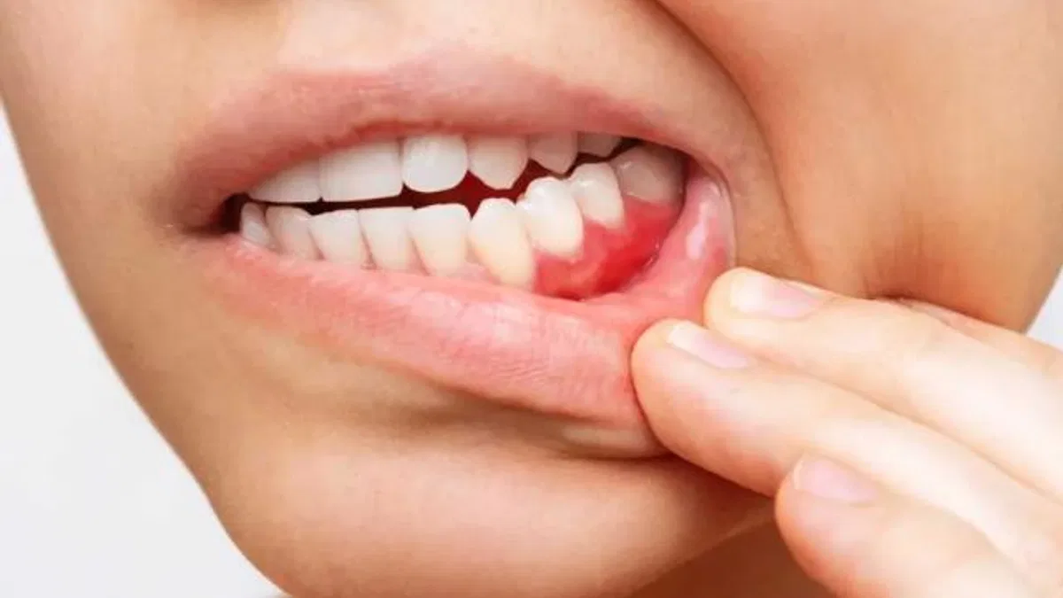Dişeti hastalıkları kalp sağlığını tehdit ediyor